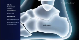 Calcaneal Sliding Osteotomy